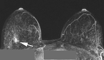 Bevacizumab and HER2-Negative Breast Cancer Bevacizumab and HER2-Negative Breast Cancer