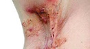 Hidradenitis Suppurativa