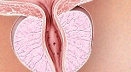 Screening for Prostate Cancer Screening for Prostate Cancer