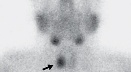 Primary Hyperparathyroidism Primary Hyperparathyroidism