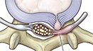 Lumbar Microdiskectomy Lumbar Microdiskectomy