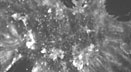 MYO1E Mutations and Childhood Familial FSGS MYO1E Mutations and Childhood Familial FSGS