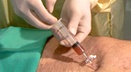 Emergency Pericardiocentesis