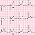 A Man with Acute Chest Pain