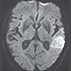 Secondary Prevention after Ischemic Stroke or TIA Secondary Prevention after Ischemic Stroke or TIA
