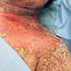 A Woman with Fever and a Generalized Rash A Woman with Fever and a Generalized Rash