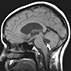 A Woman with Diplopia, Headaches, and Papilledema A Woman with Diplopia, Headaches, and Papilledema