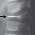 Vertebra Plana Vertebra Plana