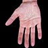 Aquagenic Wrinkling of Palms in Cystic Fibrosis Aquagenic Wrinkling of Palms in Cystic Fibrosis