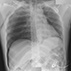 Deep Sulcus Sign