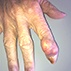 Tophaceous Gout Tophaceous Gout