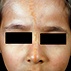 Nevus Sebaceous