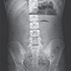 Meconium-like Ileus in Cystic Fibrosis Meconium-like Ileus in Cystic Fibrosis