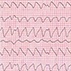 An Electrocardiographic Sine Wave in Hyperkalemia