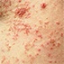 Refractory Pruritic Rash Refractory Pruritic Rash