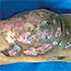 Chronic Cutaneous Lesions