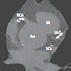 Interpreting the Coronary-Artery Calcium Score Interpreting the Coronary-Artery Calcium Score