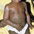 Measles in the 21st Century Measles in the 21st Century