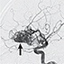Cerebral Arteriovenous Malformations