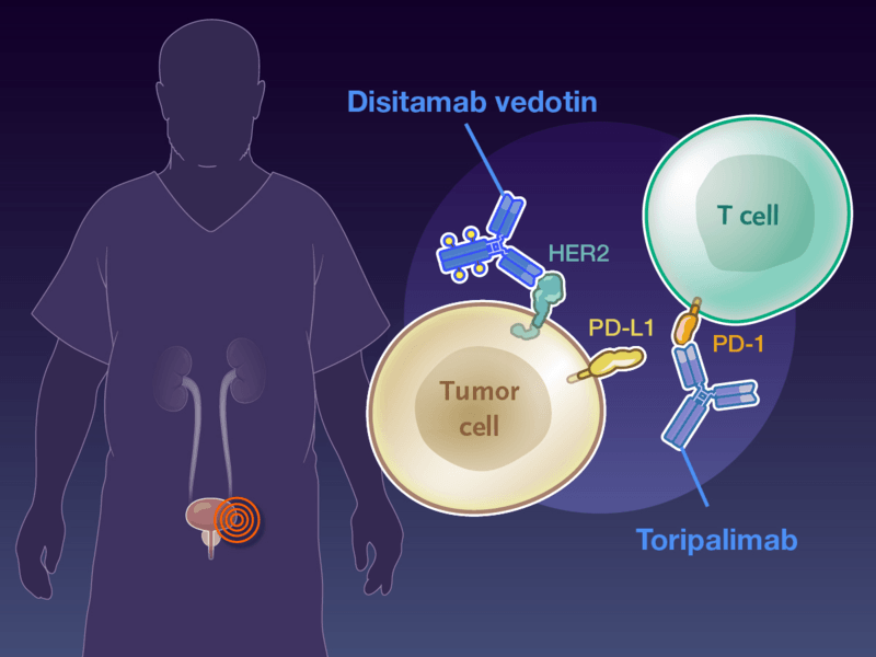 Disitamab Vedotin–Toripalimab in Urothelial Cancer